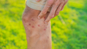 Common Spring Allergies - insect bites