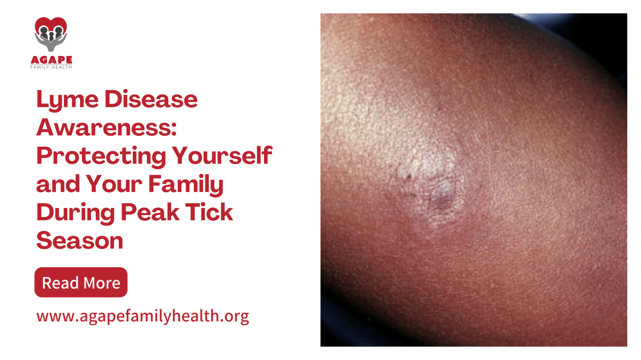 blog banner for Lyme Disease Awareness