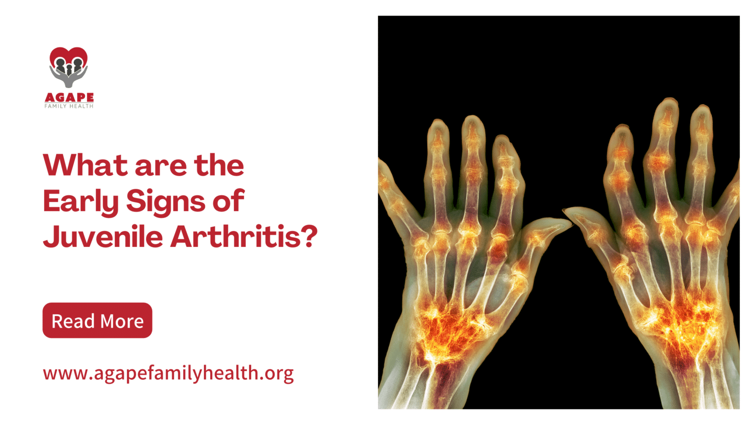 What are the Early Signs of Juvenile Arthritis?